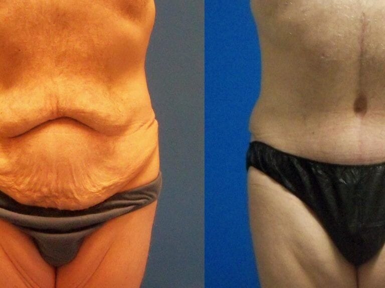 Extreme Tummy Tuck Before & After
