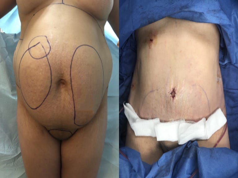 Tummy Tuck Before & Immediately After