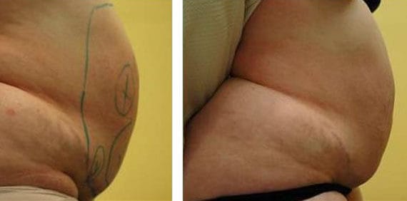 Cellulite Treatment with Mesotherapy