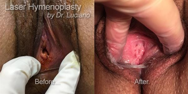 laser-hymenoplasty-by-Dr-Luciano-and-Skinsational_New