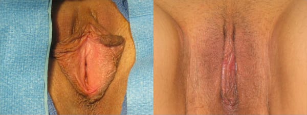 skinsational-labiaplasty-before-after-2