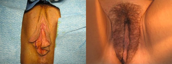 skinsational-labiaplasty-before-after-3
