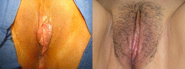 skinsational-labiaplasty-before-after-4