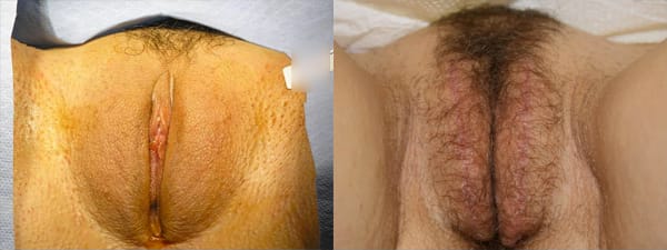 skinsational-labiaplasty-before-after-6