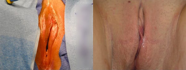 skinsational-labiaplasty-before-after-7