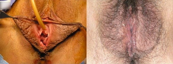 skinsational-labiaplasty-before-after-9