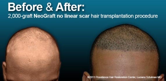 Hair transplant Carlos